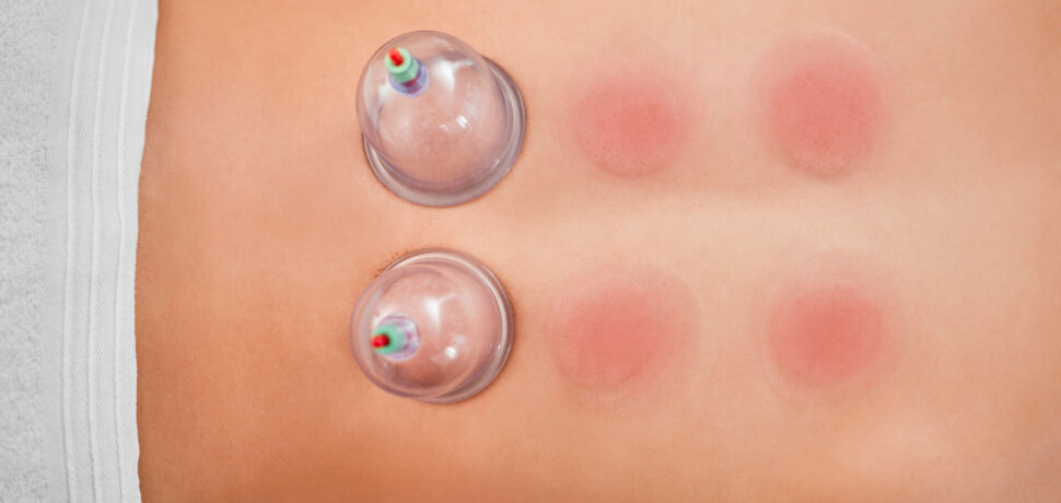 Deux ventouses posées en cours de séance de Hijama médicale