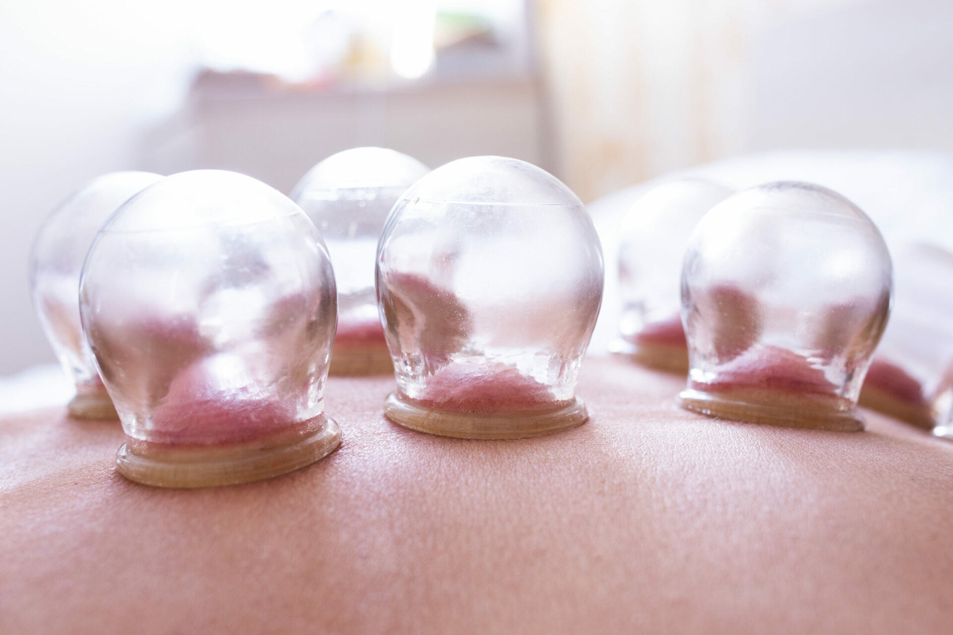 Ventouses de Hijama posées sur le dos | soins au cabinet du Dr. BOUHOUT à Salé