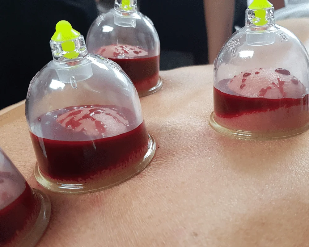 Hijama humide — schéma de la scarification superficielle et du drainage capillaire-lymphatique