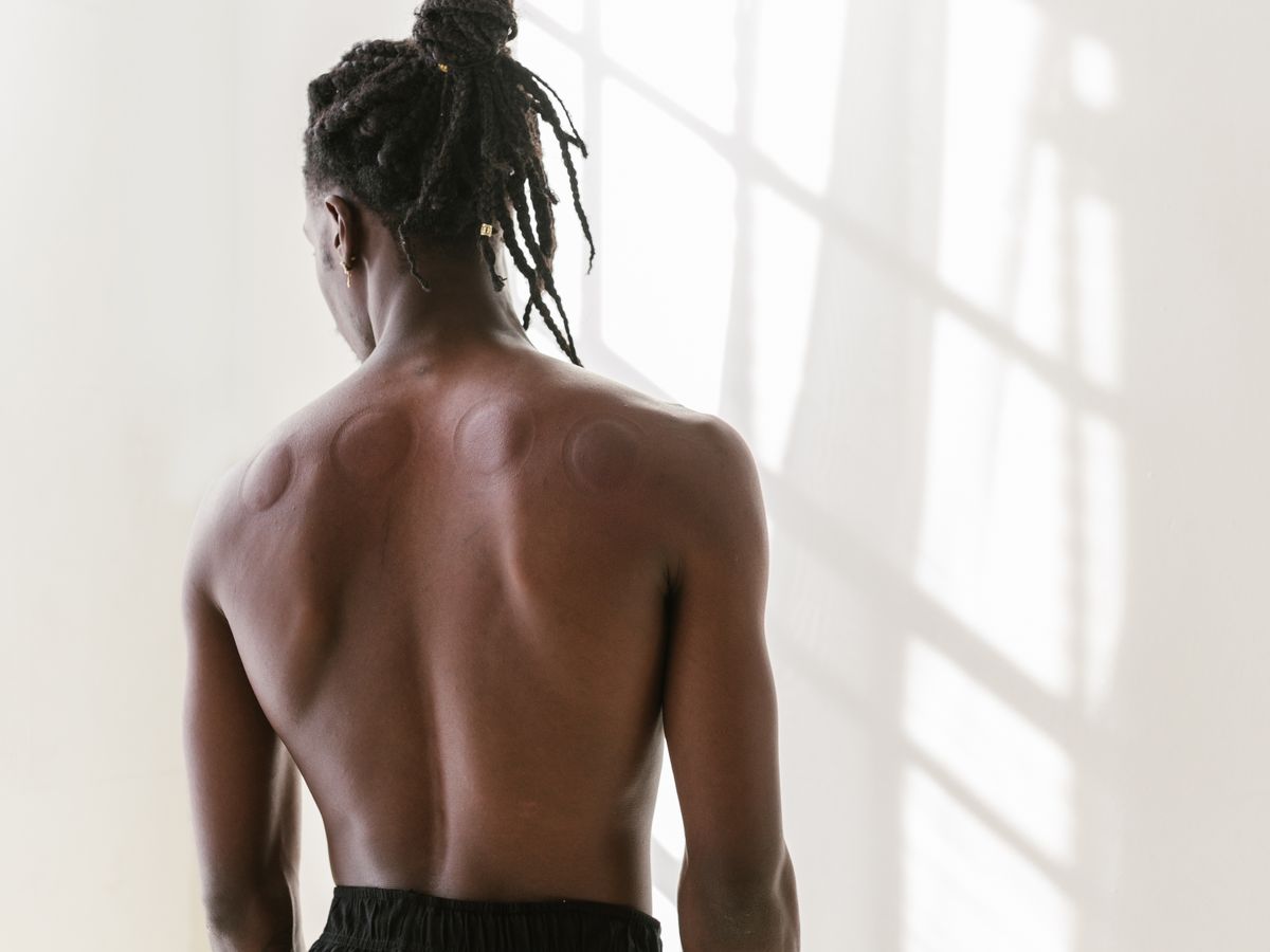 Hijama sportive — récupération musculaire
